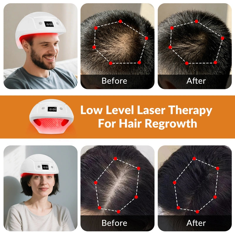 Toponechoice- Laser Red Light Therapy for Hair Growth System