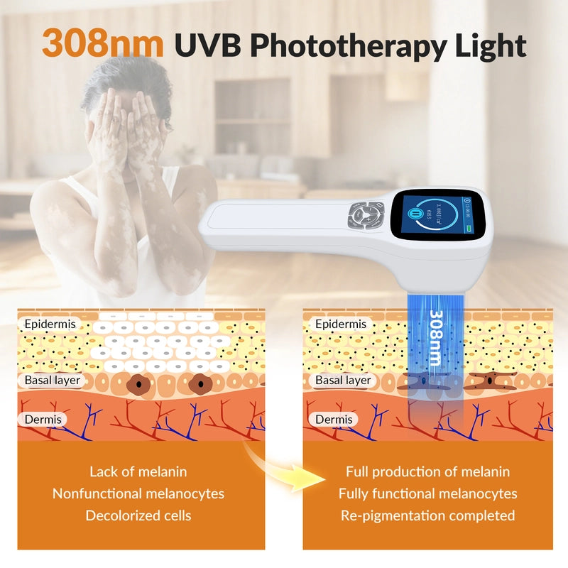 Handheld 308nm Laser UVB Light Therapy At Home For Vitiligo and Psoriasis