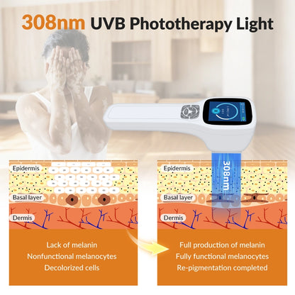 Handheld 308nm Laser UVB Light Therapy At Home For Vitiligo and Psoriasis