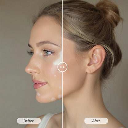 Portable 308nm UVB Phototherapy Device – Effective for Vitiligo & Psoriasis at Home