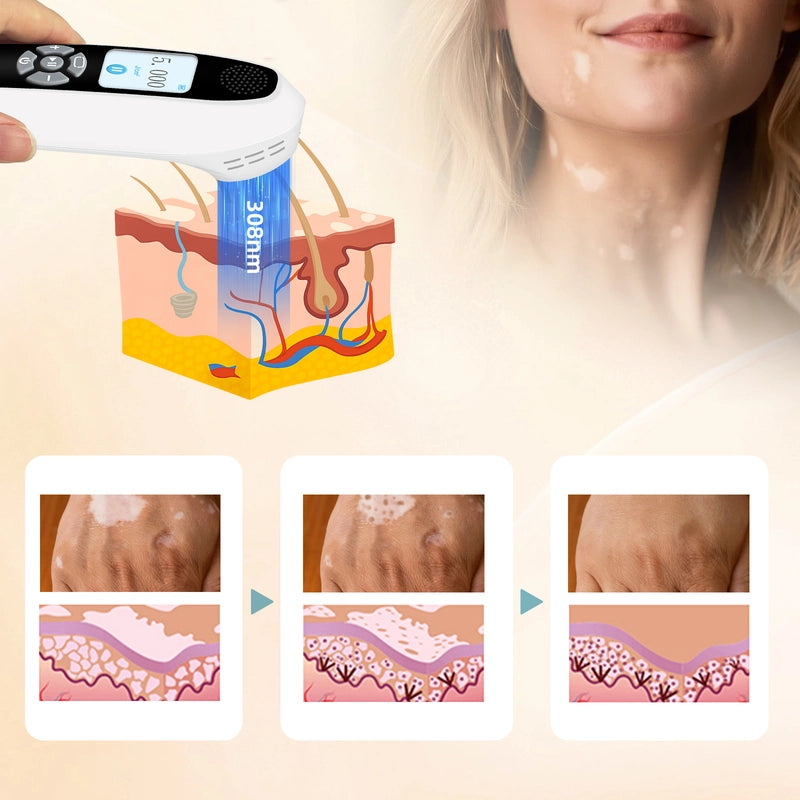 Portable 308nm UVB Phototherapy Device – Effective for Vitiligo & Psoriasis at Home
