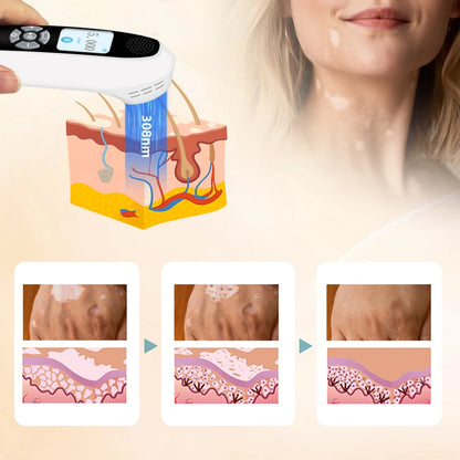 Portable 308nm UVB Phototherapy Device – Effective for Vitiligo & Psoriasis at Home